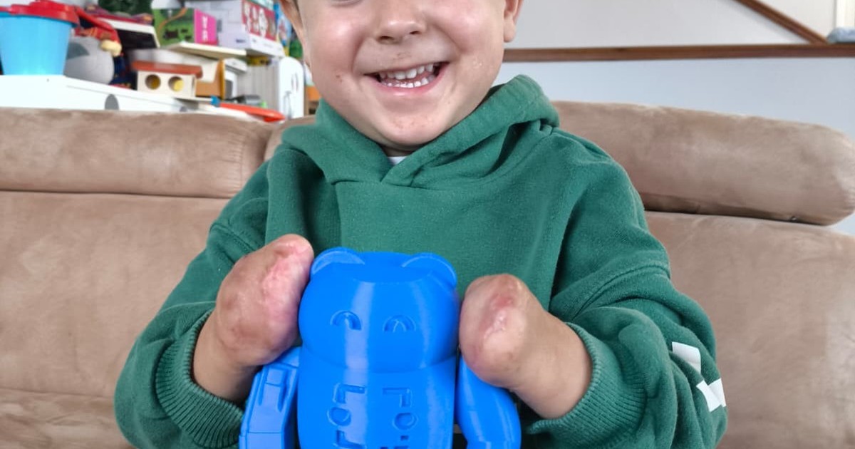 Niño con prótesis caminando acompañado de un adulto